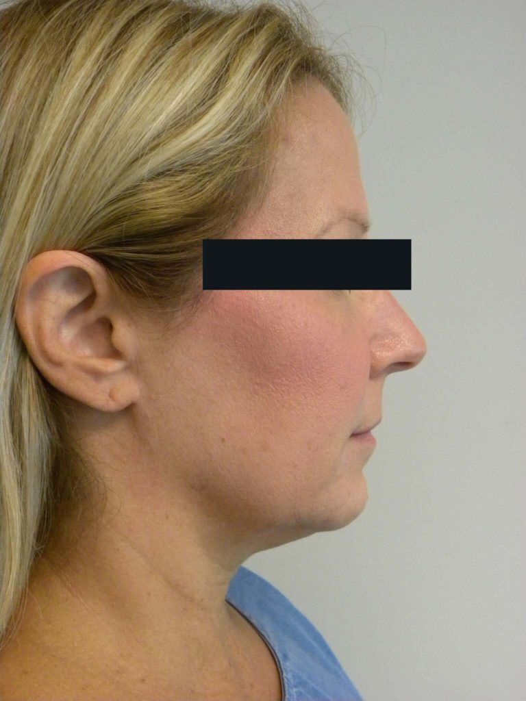 Neck Lift Before and After Pictures Miami, FL