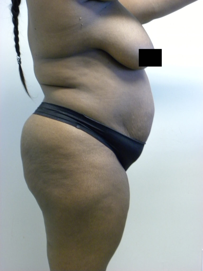 Tummy Tuck Before and After Pictures Miami, FL