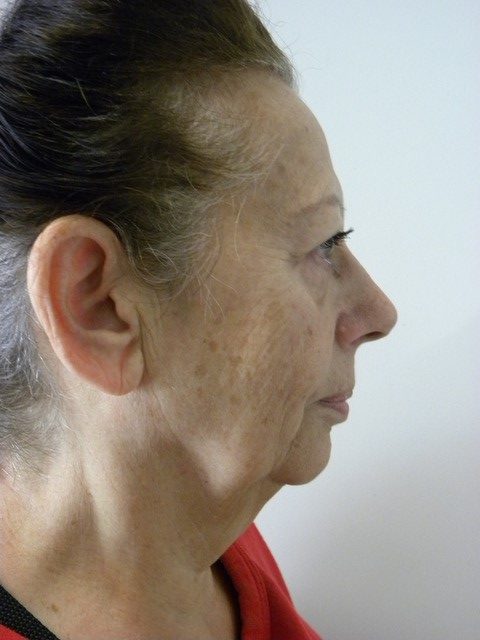 Facelift Before and After Pictures in Miami, FL