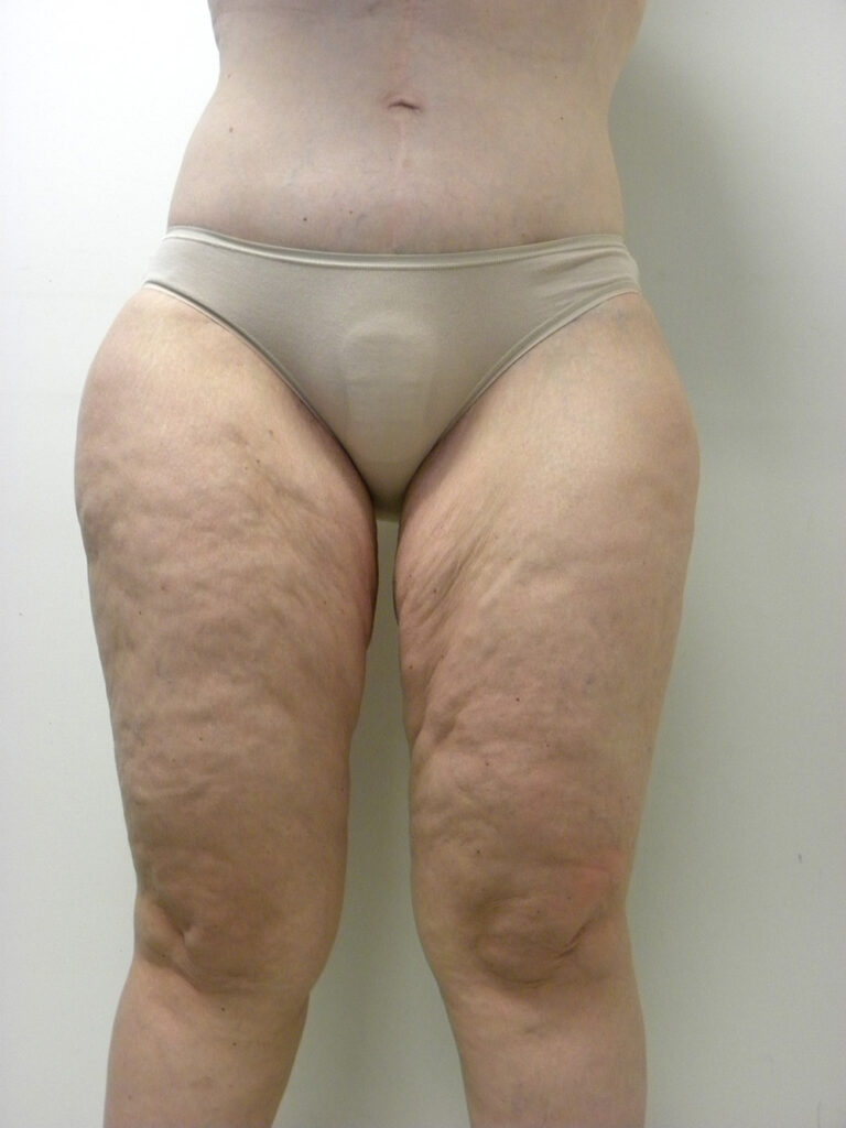 Thigh Lift Before and After Pictures in Miami, FL