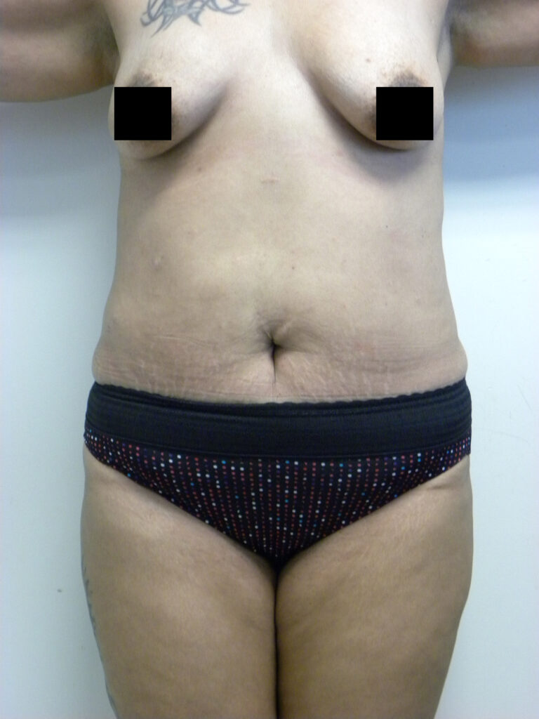 Tummy Tuck Before and After Pictures in Miami, FL