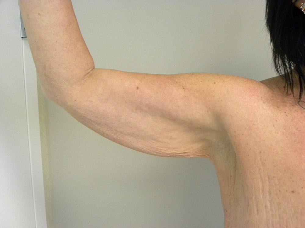 Arm Lift Before and After Pictures Miami, FL