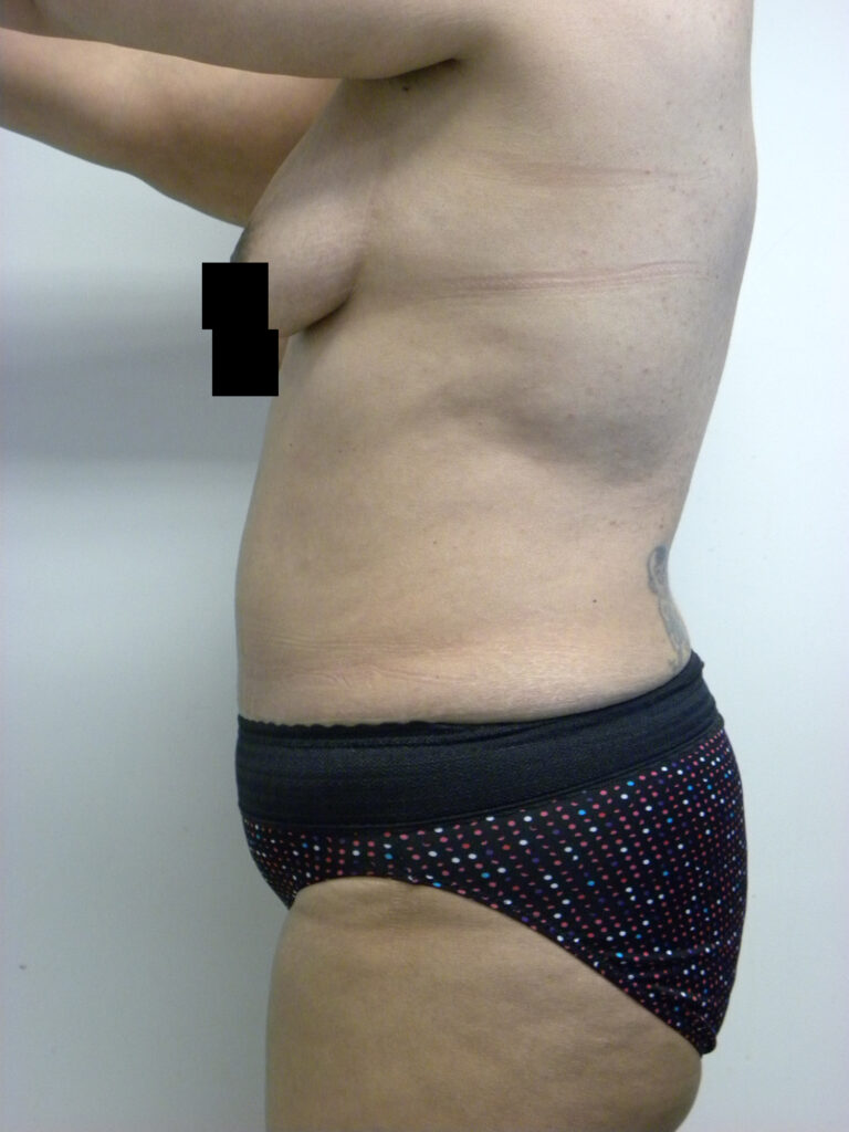 Tummy Tuck Before and After Pictures in Miami, FL