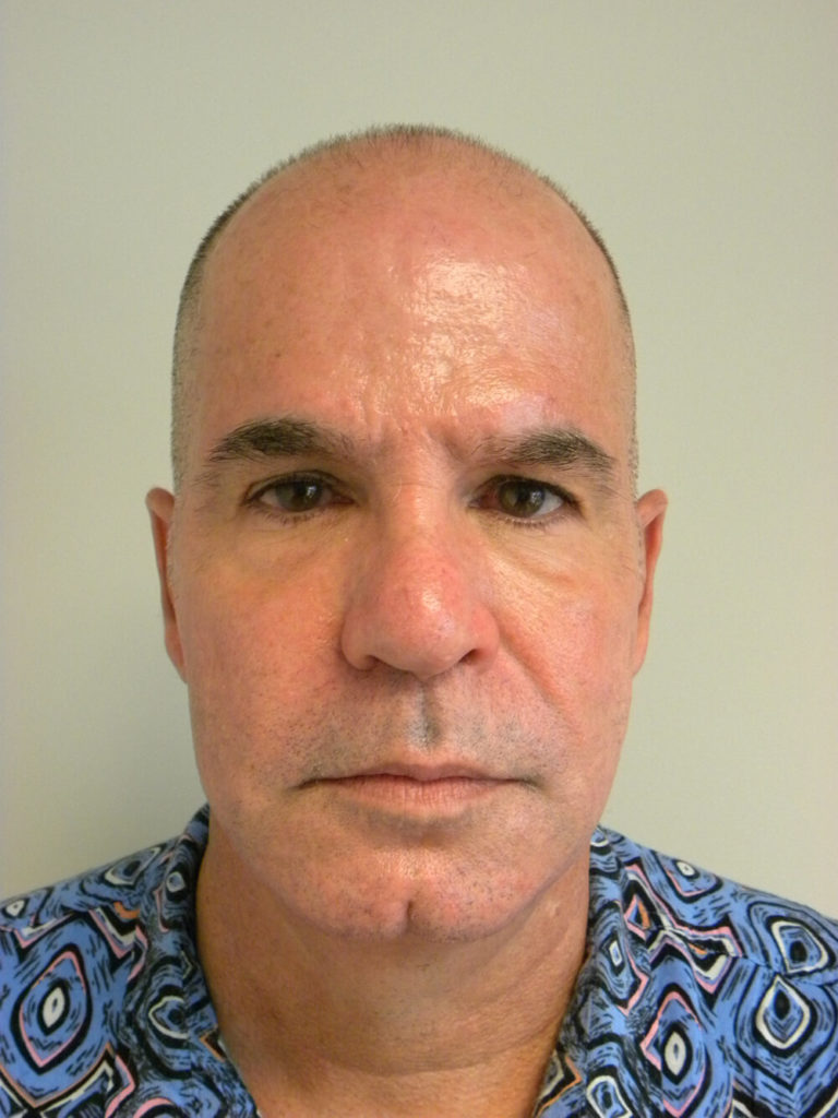 Male Neck Lift Before and After Pictures Miami, FL