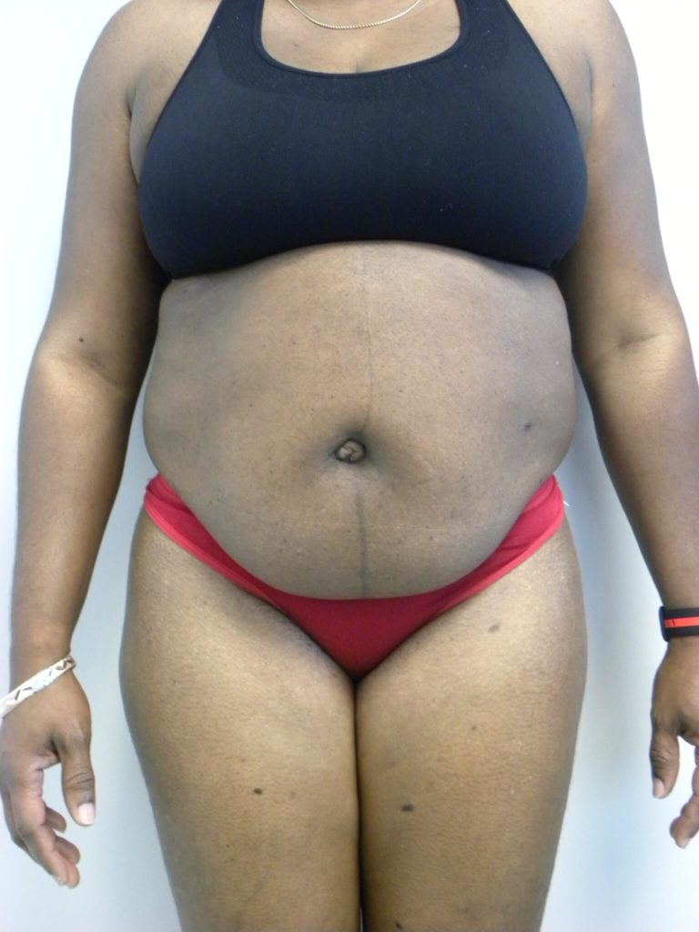 Tummy Tuck Before and After Pictures Miami, FL