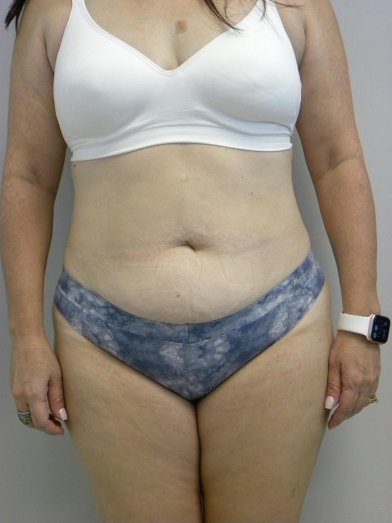 Tummy Tuck Before and After Pictures Miami, FL