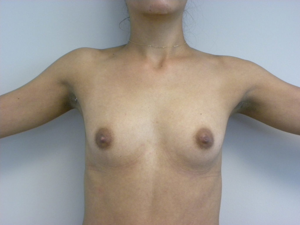 BREAST AUGMENTATION BEFORE AND AFTER PICTURES IN MIAMI, FL