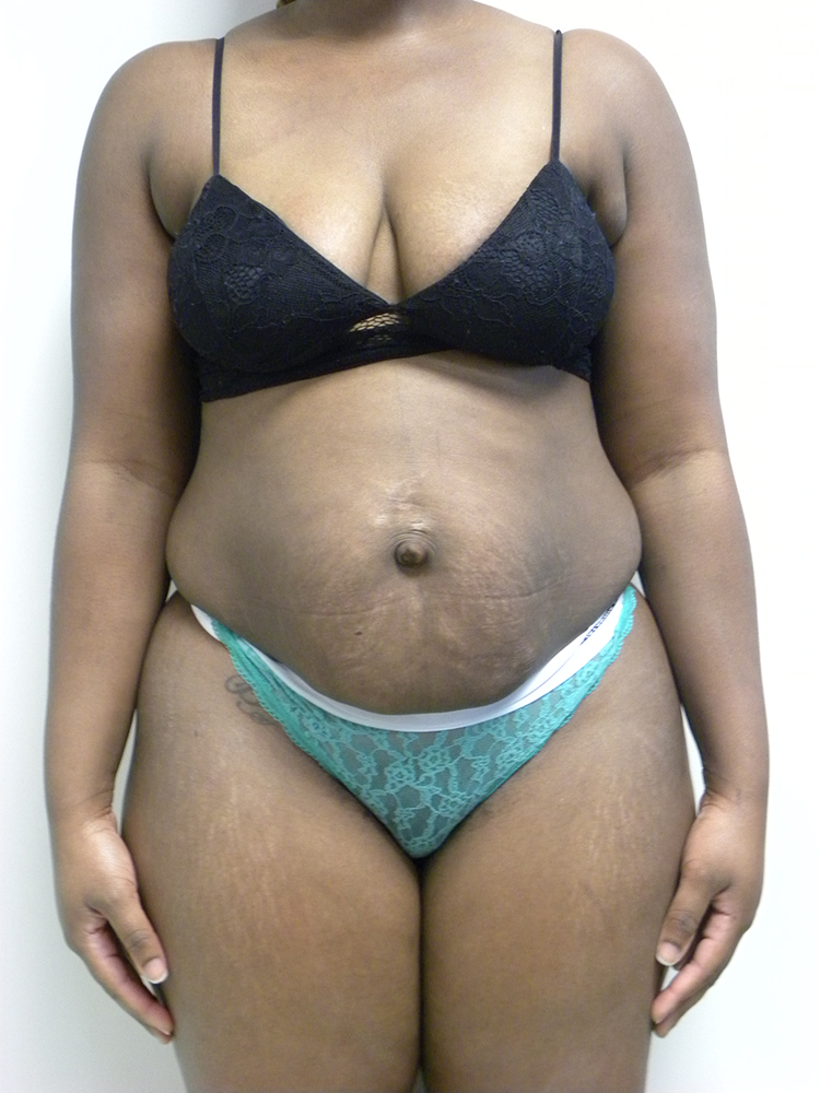 Tummy Tuck Before and After Pictures in Miami, FL