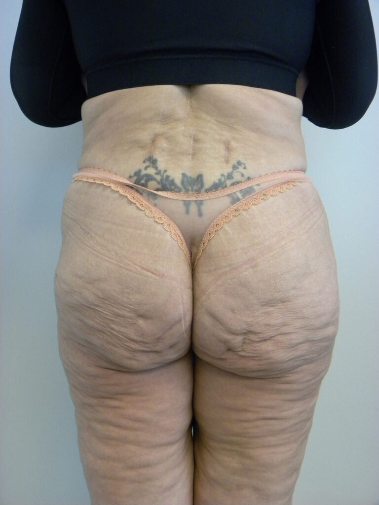 Plastic Surgery Before and After Pictures in Miami, FL - Dr. Adam J. Rubinstein 