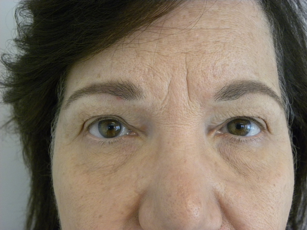 BLEPHAROPLASTY BEFORE AND AFTER PICTURES IN MIAMI, FL