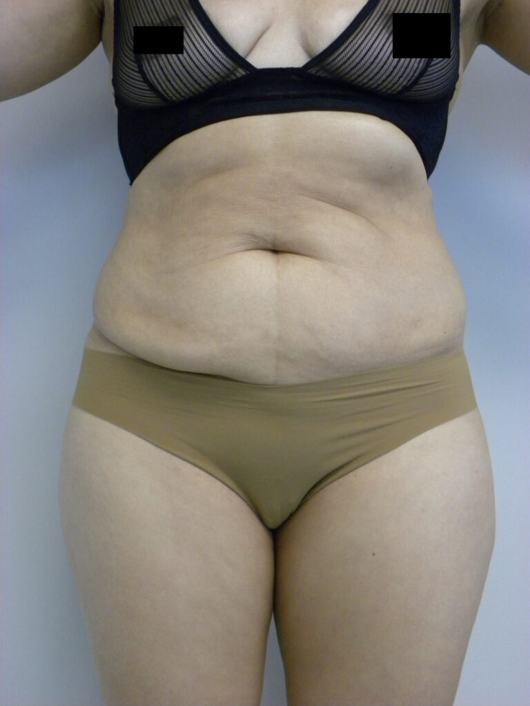 Tummy Tuck Before and After Pictures Miami, Aventura, FL