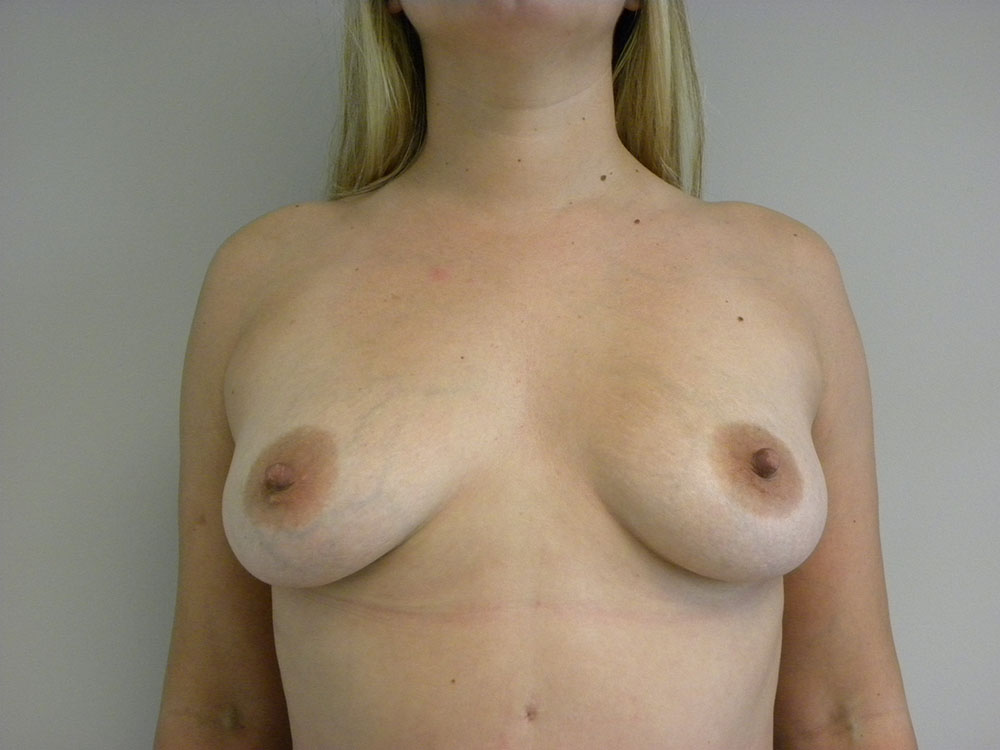 Plastic Surgery Before and After Pictures in Miami, FL - Dr. Adam J. Rubinstein 