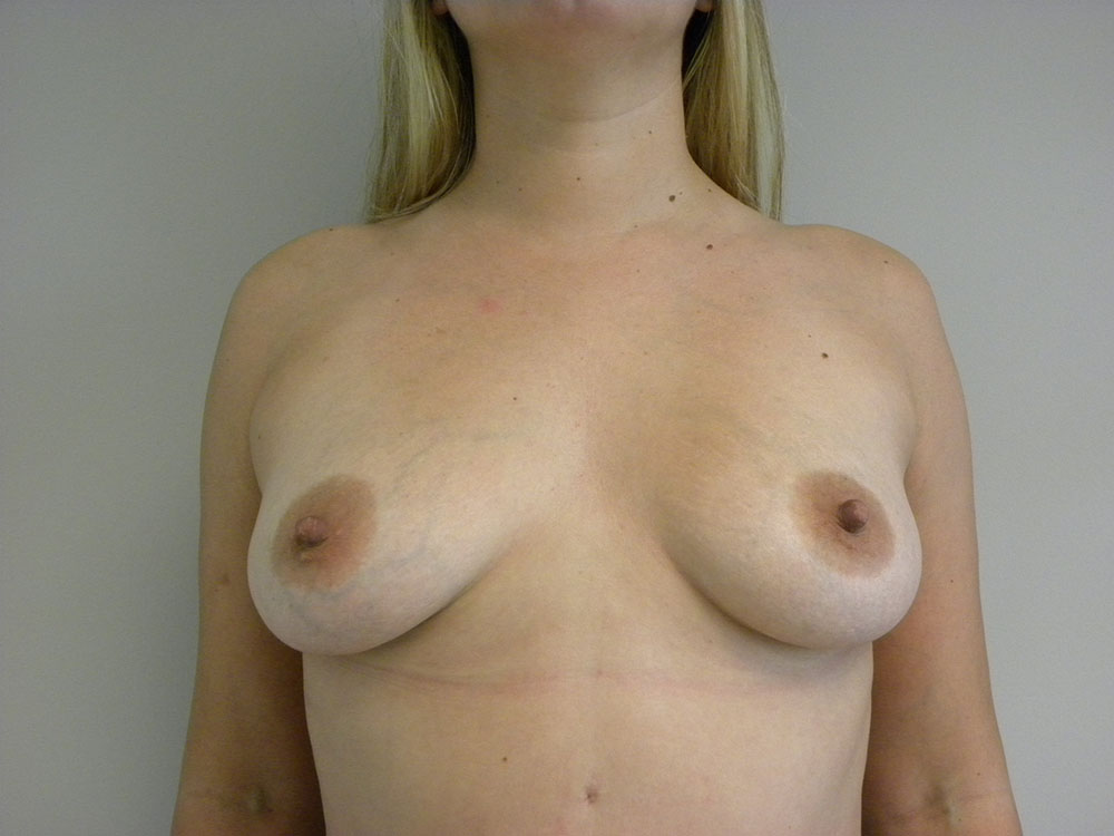 BREAST AUGMENTATION BEFORE AND AFTER PICTURES IN MIAMI, FL