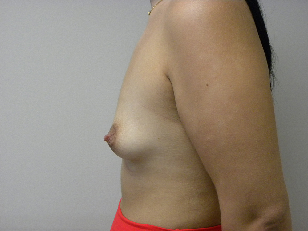 Plastic Surgery Before and After Pictures in Miami, FL - Dr. Adam J. Rubinstein 