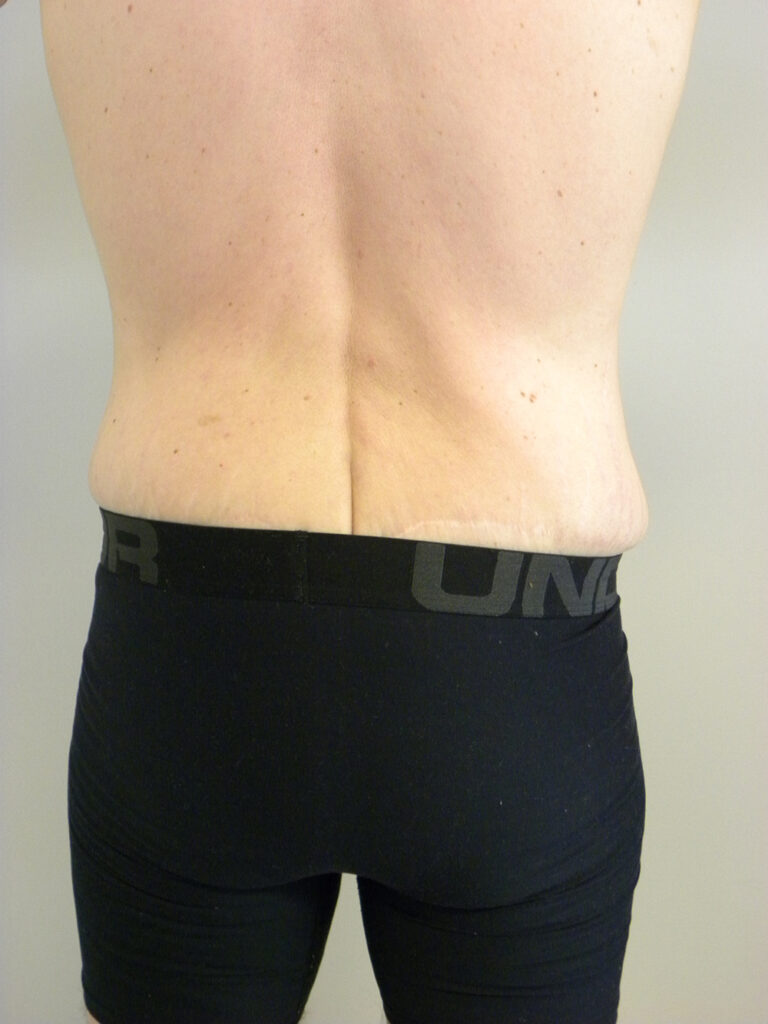 Plastic Surgery Before and After Pictures in Miami, FL - Dr. Adam J. Rubinstein 