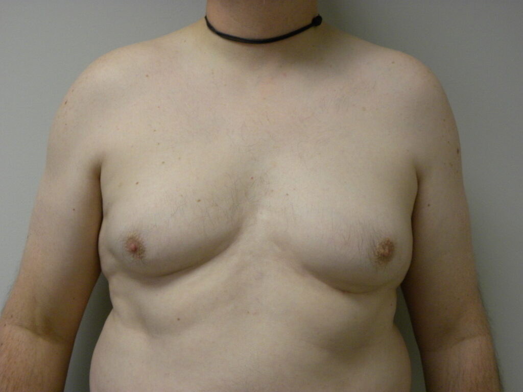 Plastic Surgery Before and After Pictures in Miami, FL - Dr. Adam J. Rubinstein 