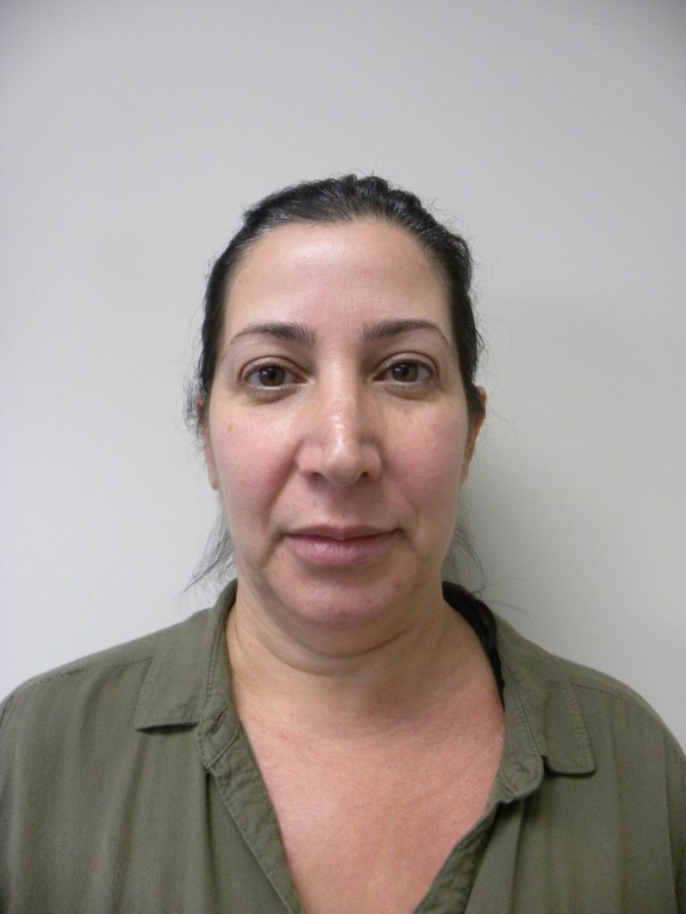 Neck Lift Before and After Pictures Miami, FL