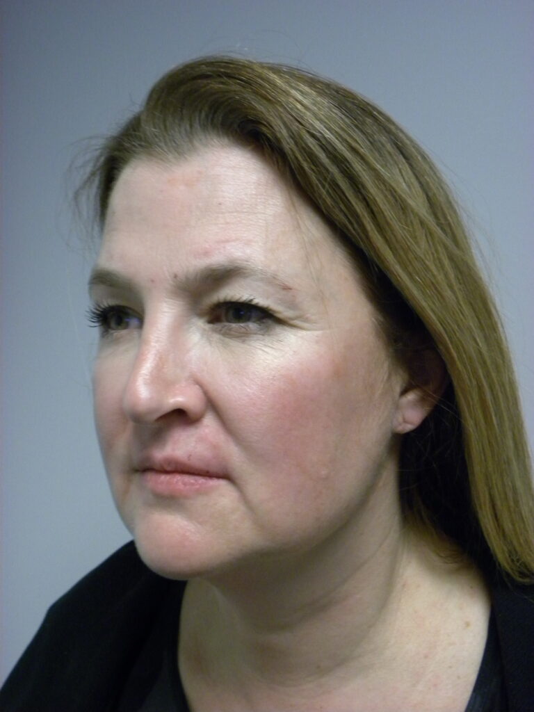Plastic Surgery Before and After Pictures in Miami, FL - Dr. Adam J. Rubinstein 