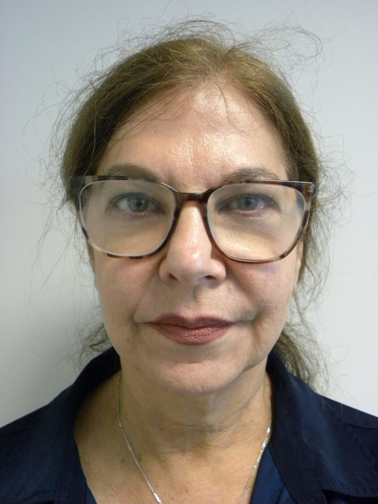 Neck Lift Before and After Pictures Miami, FL