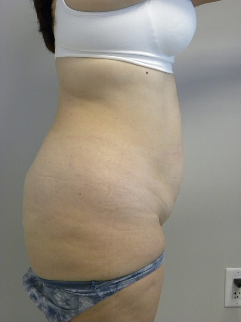 Tummy Tuck Before and After Pictures Miami, FL