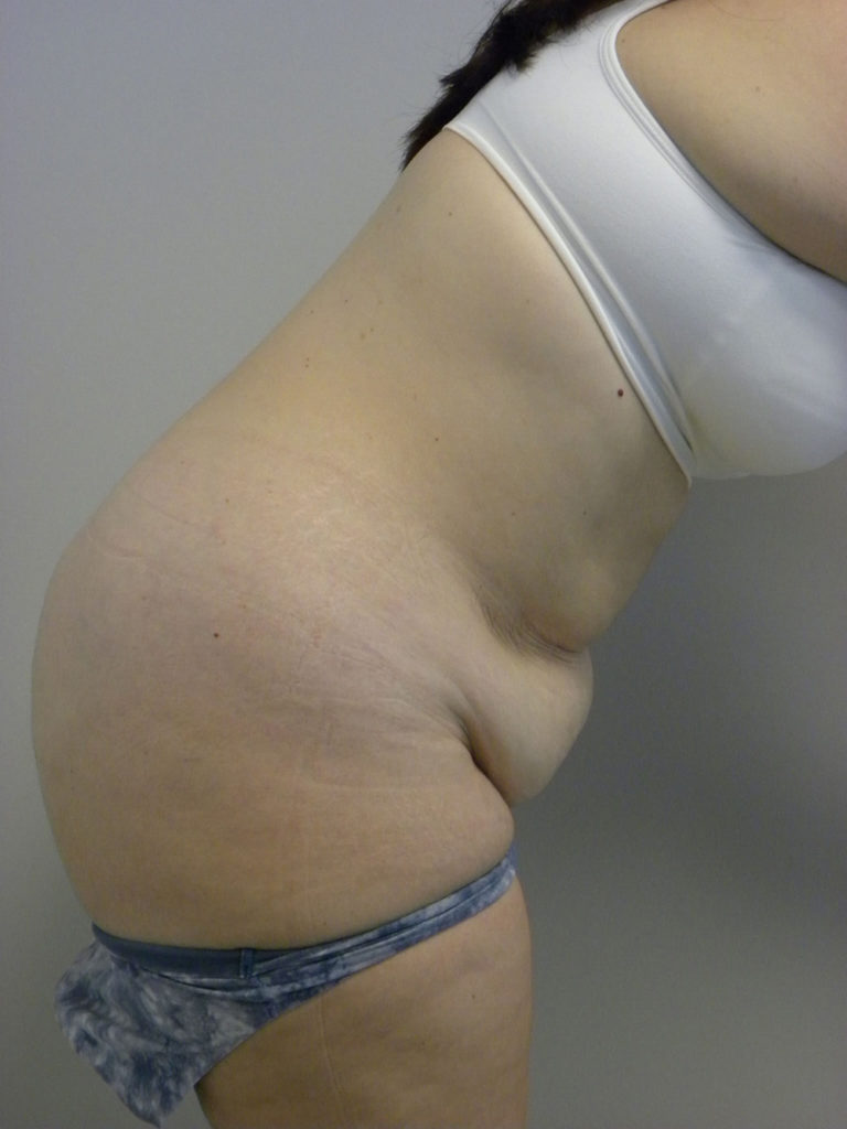 Tummy Tuck Before and After Pictures Miami, FL