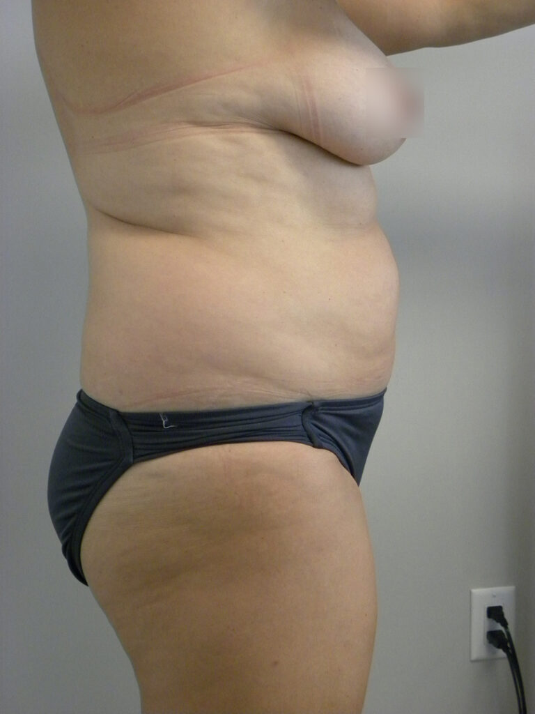 Tummy Tuck Before and After Pictures in Miami, FL