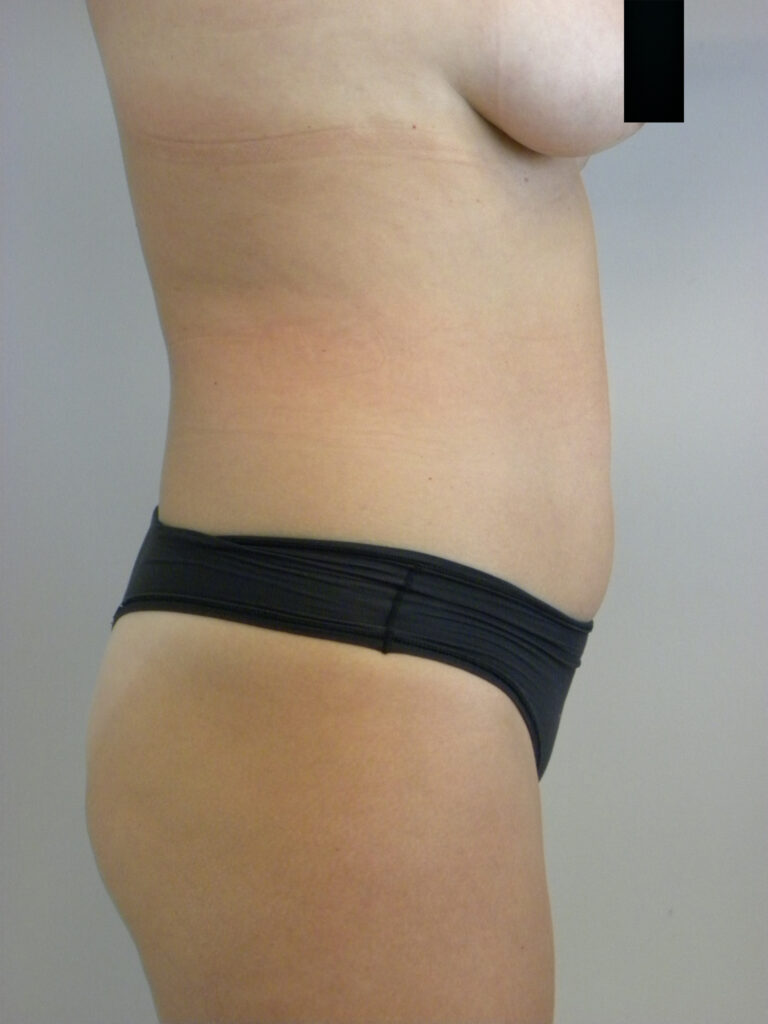 Plastic Surgery Before and After Pictures in Miami, FL - Dr. Adam J. Rubinstein 
