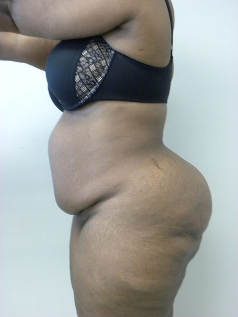 Tummy Tuck Before and After Pictures in Miami, FL