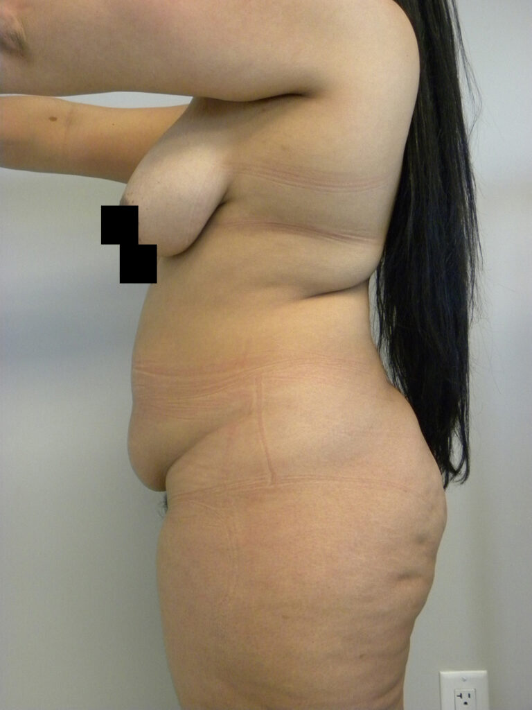 Tummy Tuck Before and After Pictures in Miami, FL