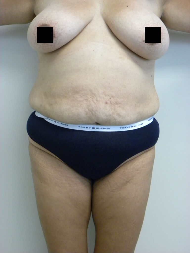 Tummy Tuck Before and After Pictures in Miami, FL