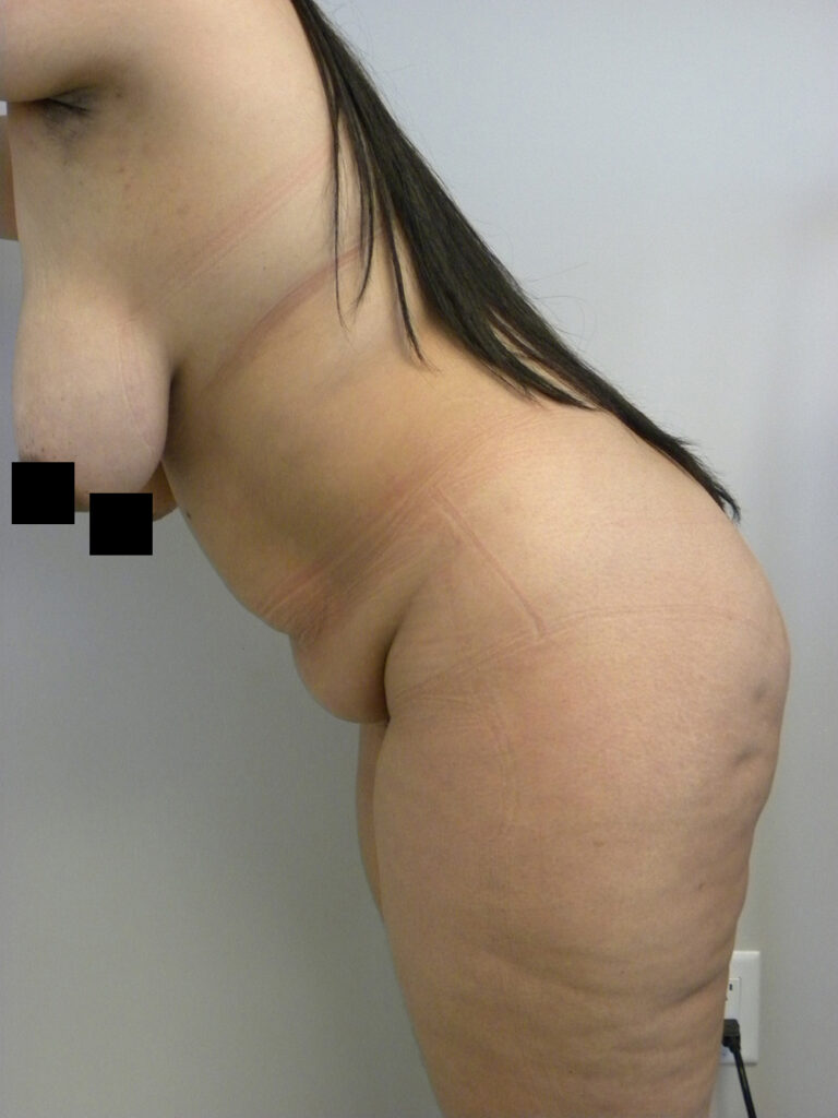 Tummy Tuck Before and After Pictures in Miami, FL