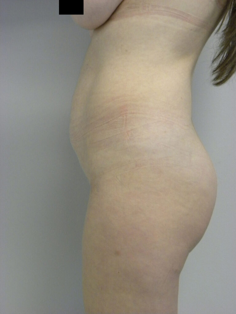 Tummy Tuck Before and After Pictures in Miami, FL