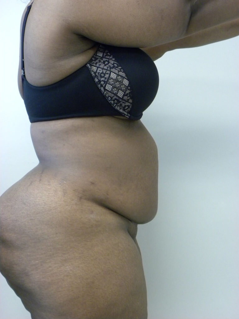 Tummy Tuck Before and After Pictures in Miami, FL