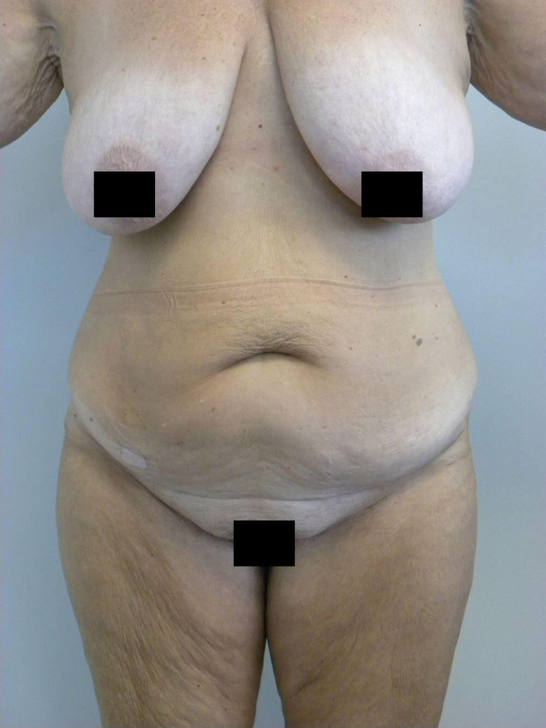 Tummy Tuck Before and After Pictures in Miami, FL