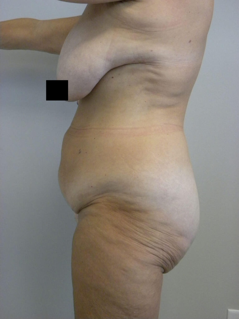 Tummy Tuck Before and After Pictures in Miami, FL