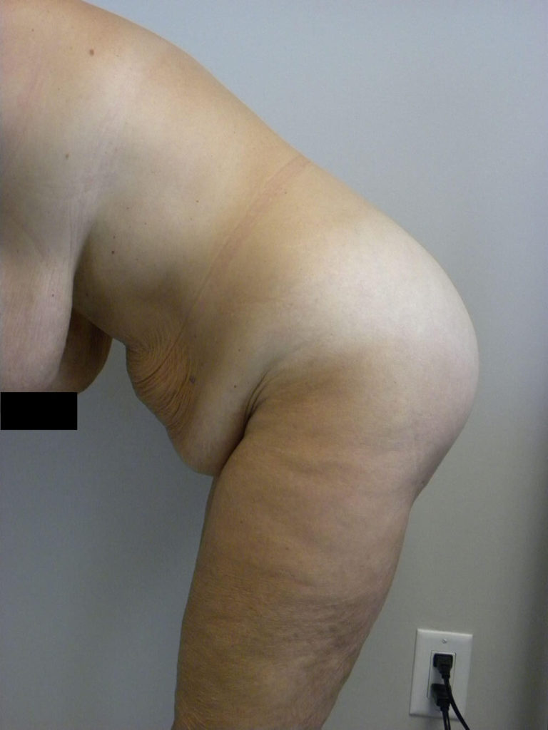 Tummy Tuck Before and After Pictures in Miami, FL