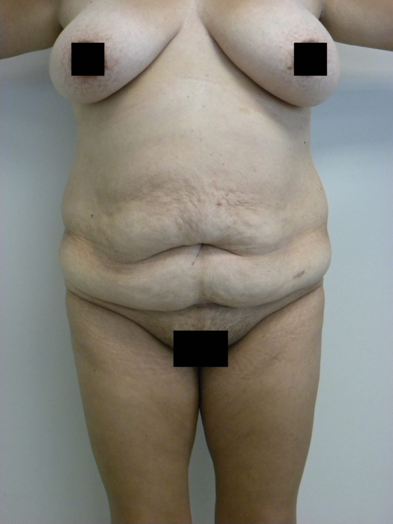 Tummy Tuck Before and After Pictures in Miami, FL