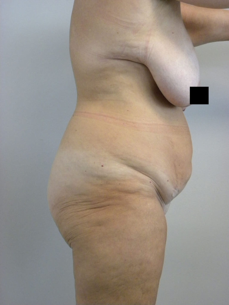 Tummy Tuck Before and After Pictures in Miami, FL