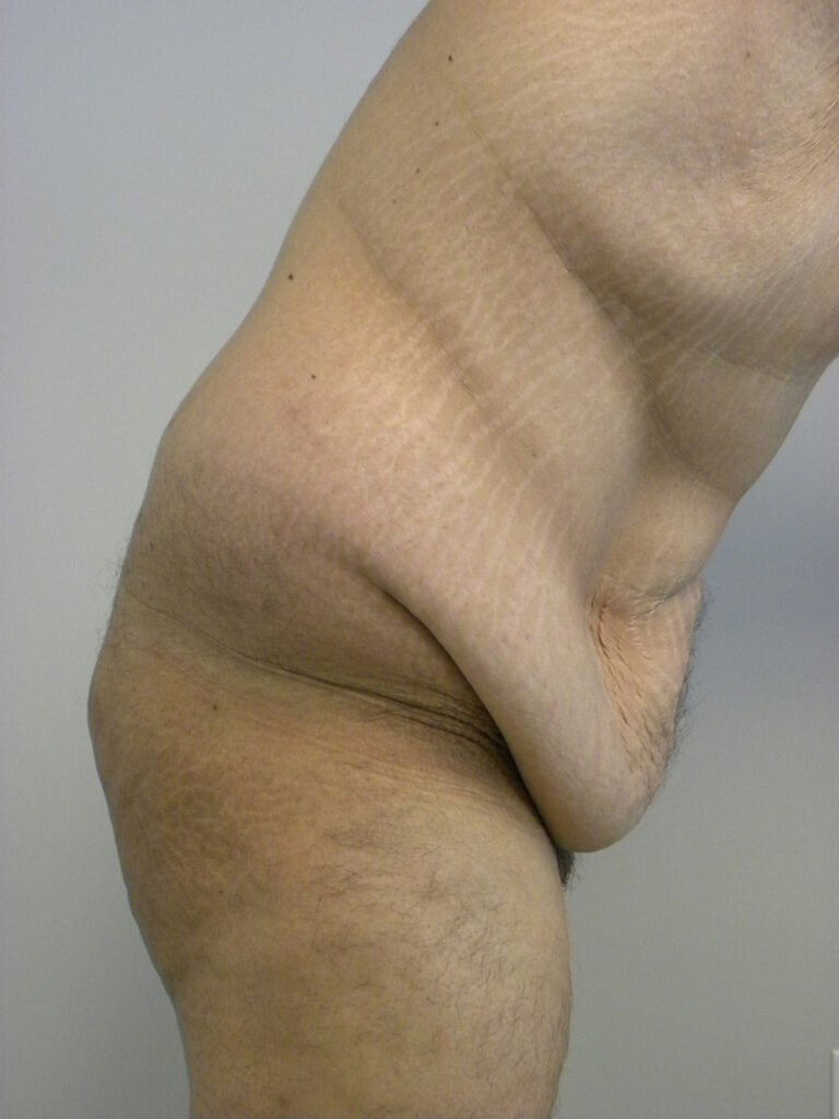 Plastic Surgery Before and After Pictures in Miami, FL - Dr. Adam J. Rubinstein 