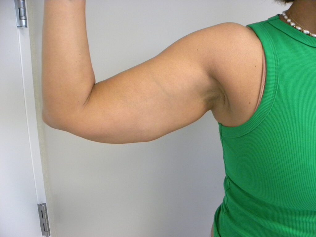 ARM LIFT BEFORE AND AFTER PICTURES IN MIAMI, FL