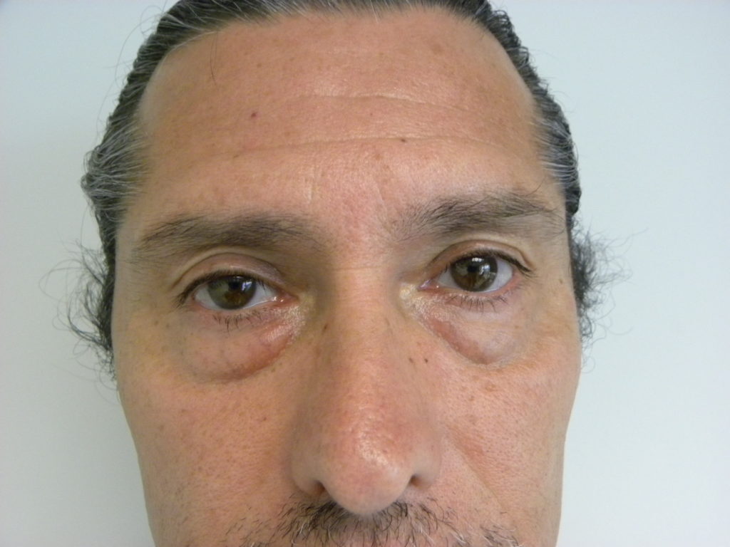 Blepharoplasty Before and After Pictures in Miami, FL