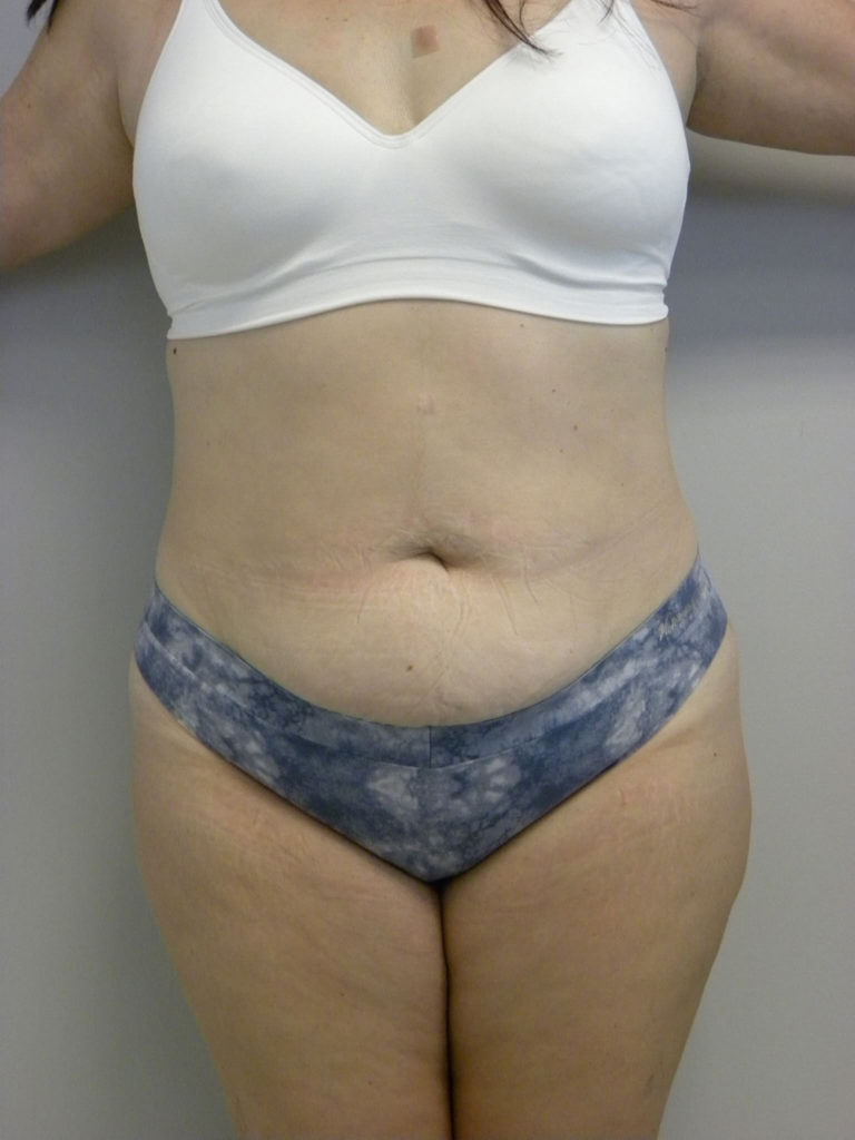 Tummy Tuck Before and After Pictures Miami, FL