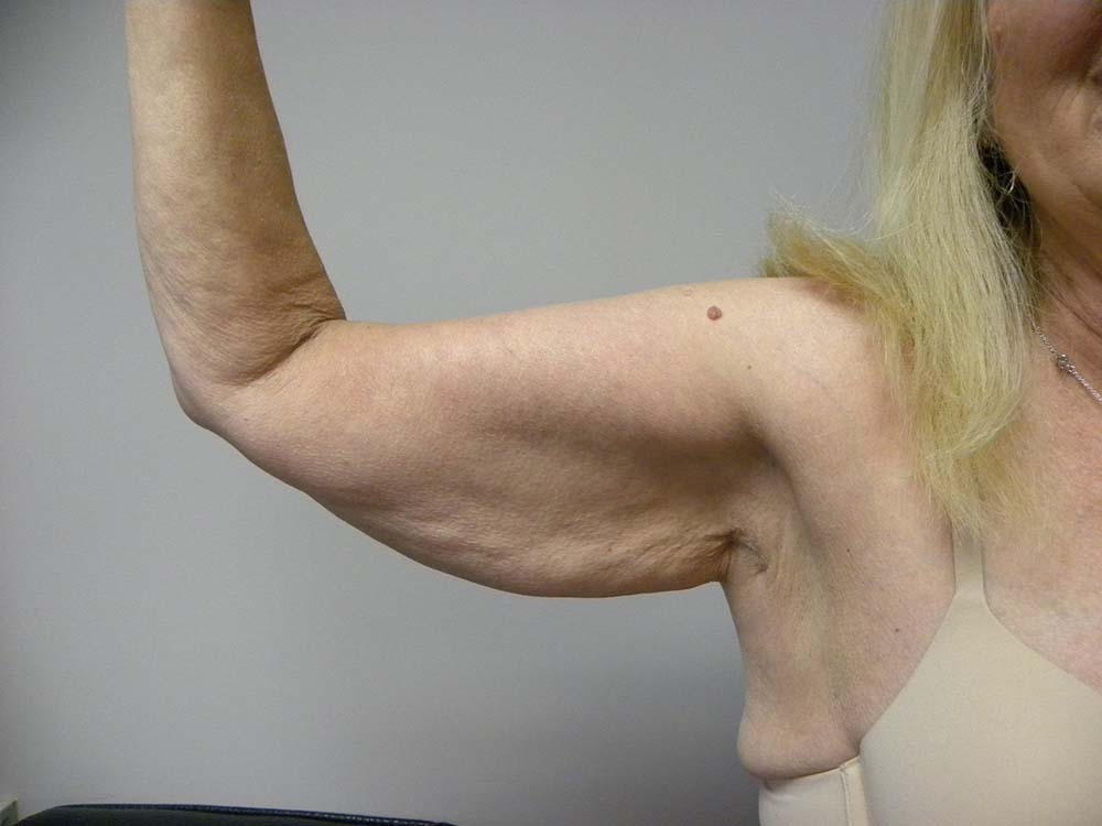 Arm Lift Before and After Pictures Miami, FL