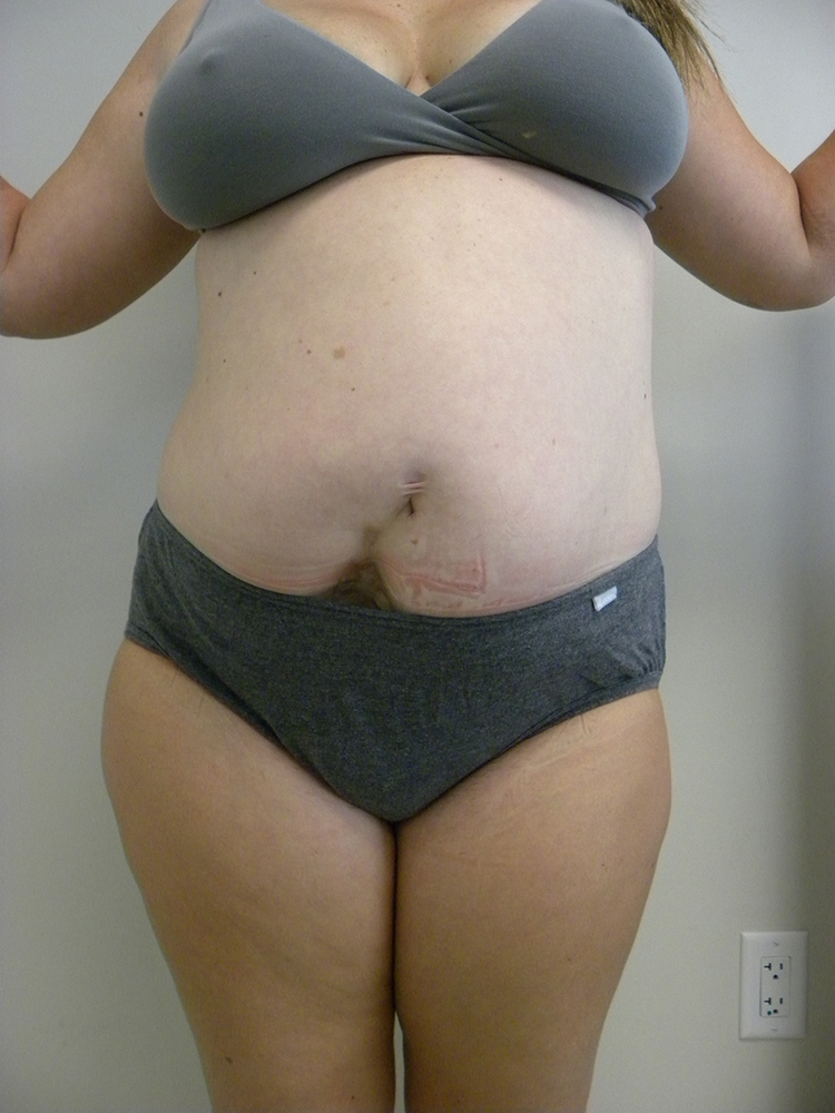 Tummy Tuck Before and After Pictures in Miami, FL