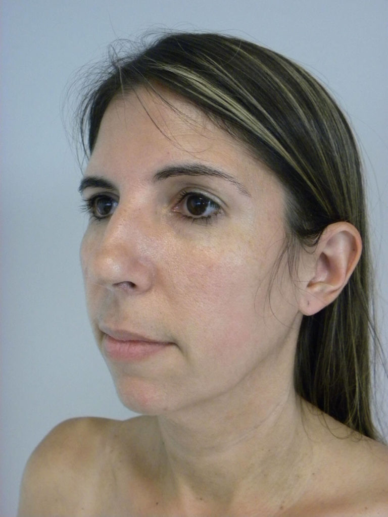 CHIN IMPLANT BEFORE AND AFTER PICTURES IN MIAMI, FL