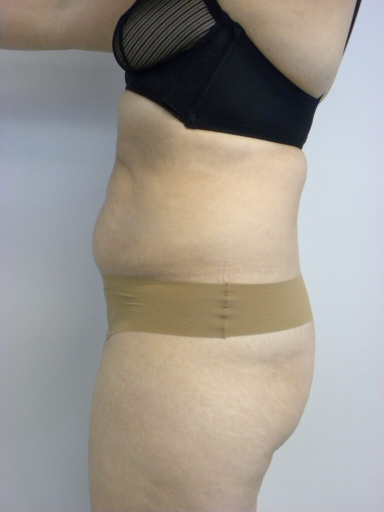 TUMMY TUCK BEFORE AND AFTER PICTURES IN MIAMI, FL