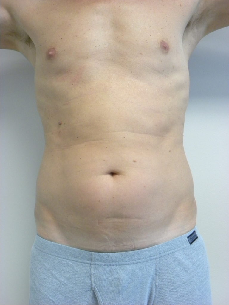 LIPOSUCTION BEFORE AND AFTER PICTURES IN MIAMI, FL