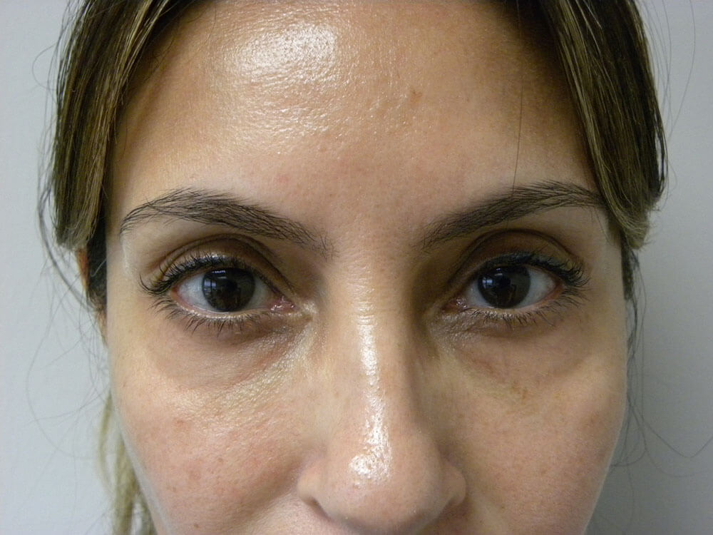 Blepharoplasty Before and After Pictures in Miami, FL