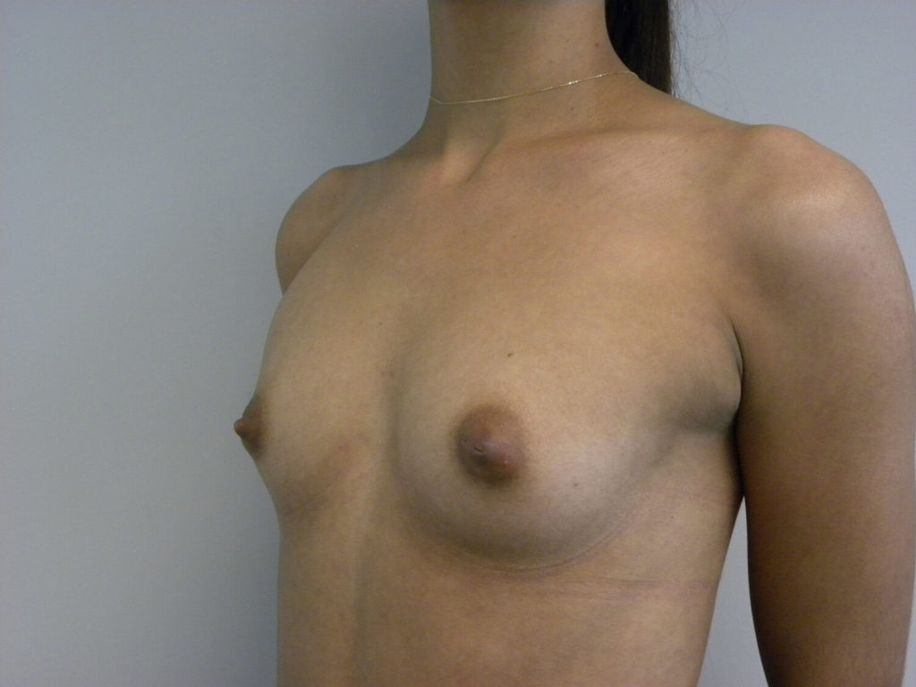 BREAST AUGMENTATION BEFORE AND AFTER PICTURES IN MIAMI, FL