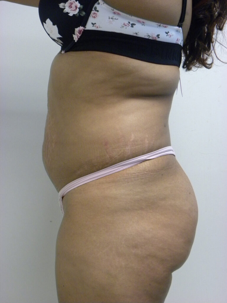 Tummy Tuck Before and After Pictures in Miami, FL